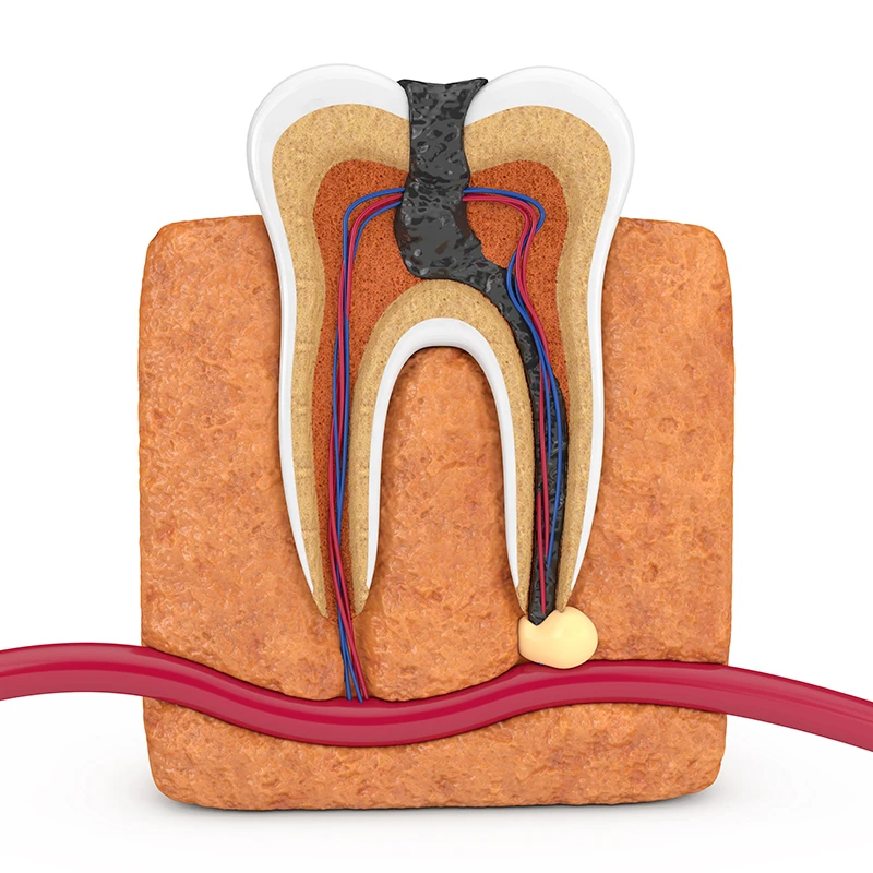 งานรักษารากฟัน (Root Canal Treatment)