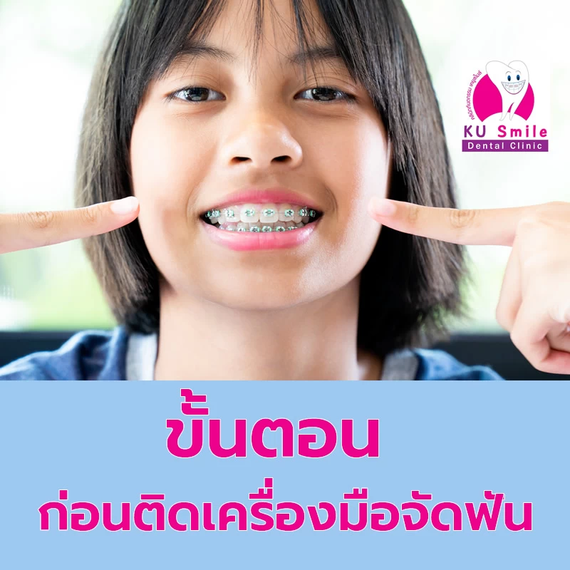 ก่อนติดเครื่องมือจัดฟัน