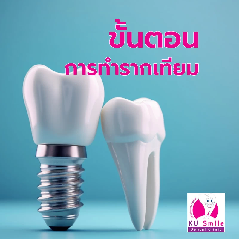 รากฟันเทียม